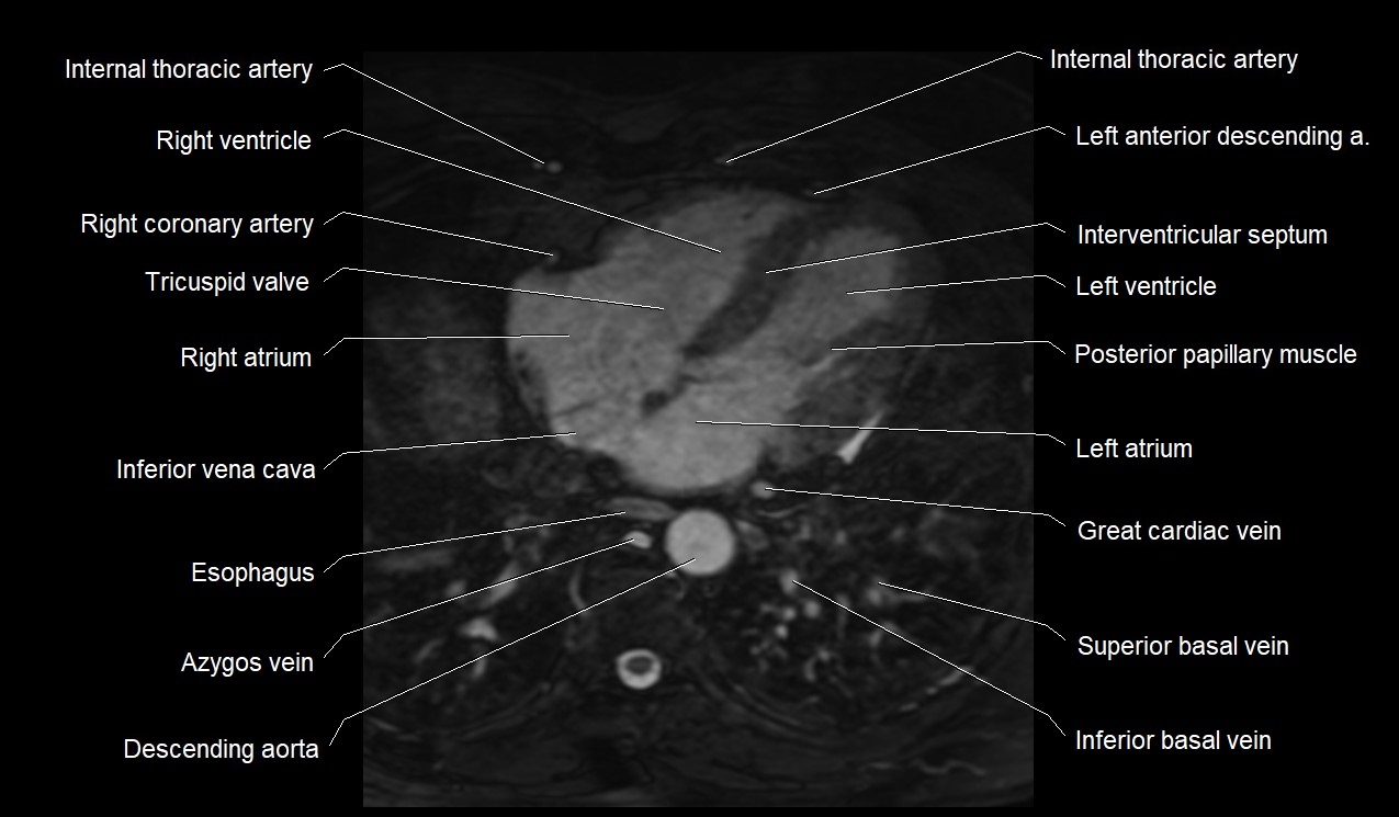 MRI heart coronary arteries and coronary veins anatomy axial image 31.jpg
